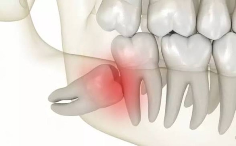 Expert Impacted Wisdom Tooth Treatment at Lansdowne Dental Centre
