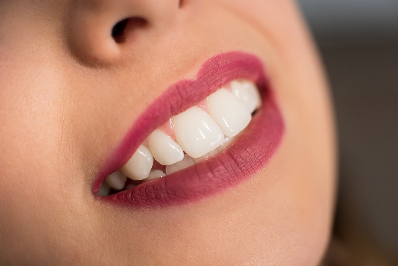 Looking for Veneers in Delta, BC — Is This Smile Treatment Right for You?
