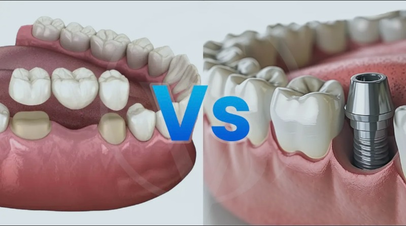 Dental Implant vs. Bridge: Which Is Right for You? A Vancouver Dentist Explains