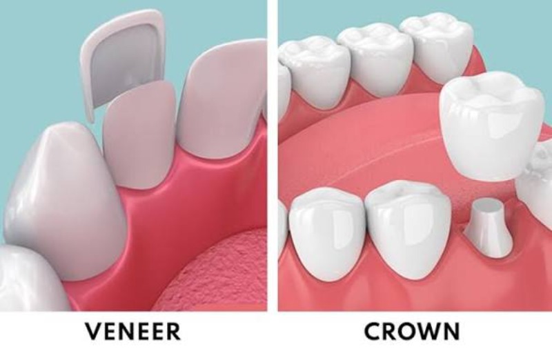 Crown vs Veneers: What’s the Difference? | Dr. Tang, Lansdowne Dental Richmond BC