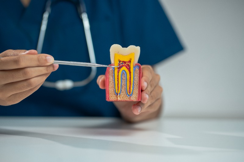 Root Canal Treatment in Vancouver — What to Expect with Dr. Cole Wedman at Georgia Dental Group