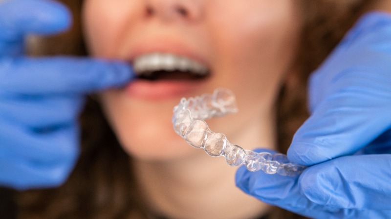 How Invisalign Works: A Richmond Dentist Explains Clear Aligners