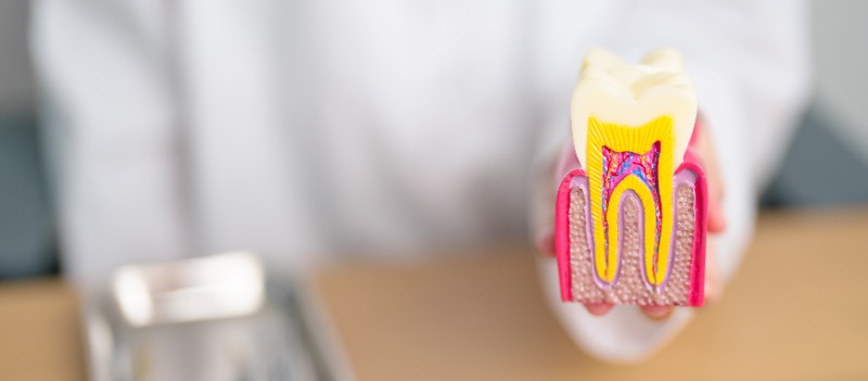 Root Canal Explained by Dr. Tang, Richmond Dentist at Lansdowne Dental Centre