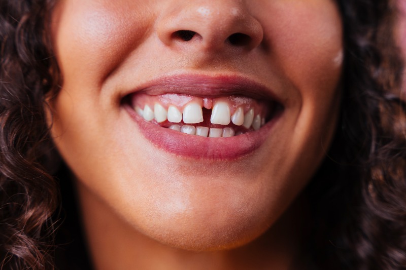 How to Fix a Gap Between Teeth (Diastema): Richmond Dentist Explains Cosmetic Bonding