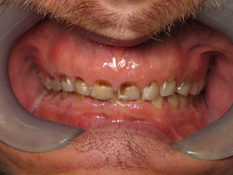 Severely Worn Teeth: How Complex Cases Can Be Rebuilt with Full Mouth Reconstruction