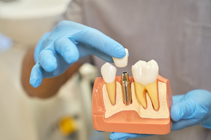 What Is a Dental Crown?Everything You Need to Know About Dental CrownsBy English Bay Dental Group and Dr. Alam