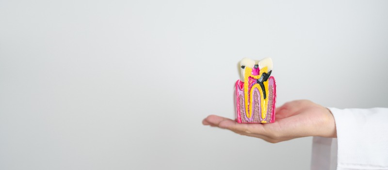 Why You Shouldn’t Delay a Root Canal Once It’s DiagnosedBy Dr. Cole Whitman of Georgia Dental Group