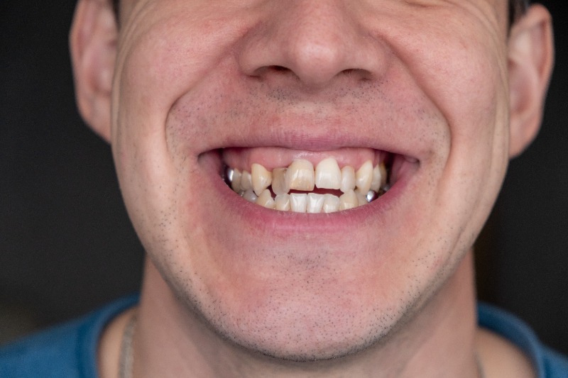 Composite Restoration for a Badly Decayed Front ToothHow a Severely Damaged Tooth Can Often Be Rebuilt Instead of RemovedBy Dr. Tang