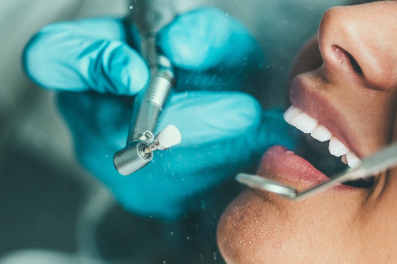 Haven’t Had a Dental Cleaning in a While? Here’s What Can Build Up on Your TeethBy Dr. Tang – Richmond Dentist at Lansdowne Dental Centre