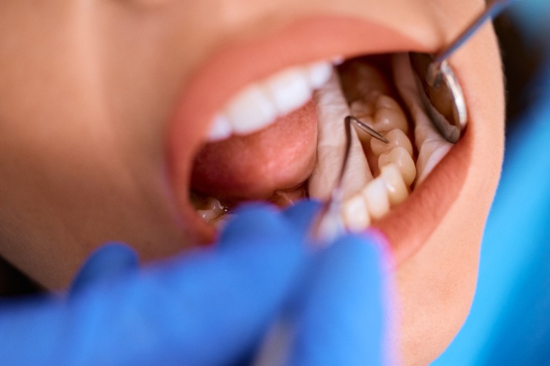 How Composite Fillings Treat Cavities While Preserving Your Natural ToothBy Dr. Tang, Richmond Dentist at Lansdowne Dental