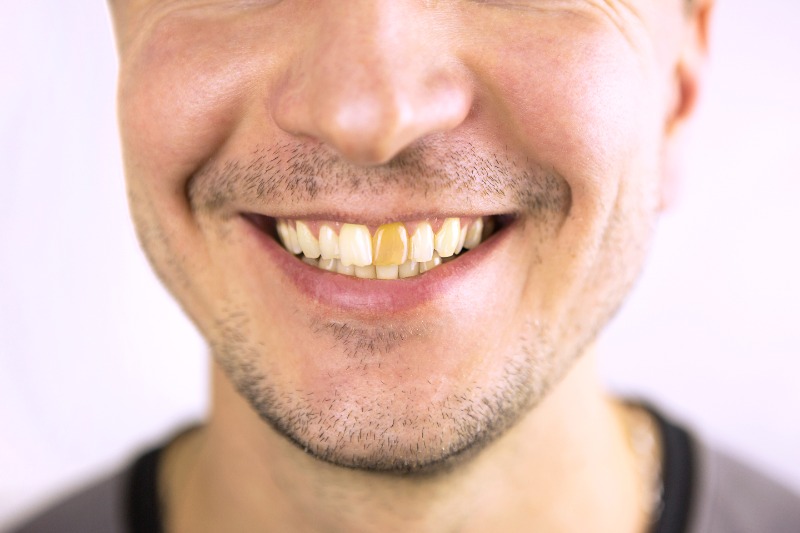 How Internal Tooth Bleaching Can Restore a Discolored Tooth By Dr. Tang, Richmond Dentist at Lansdowne Dental