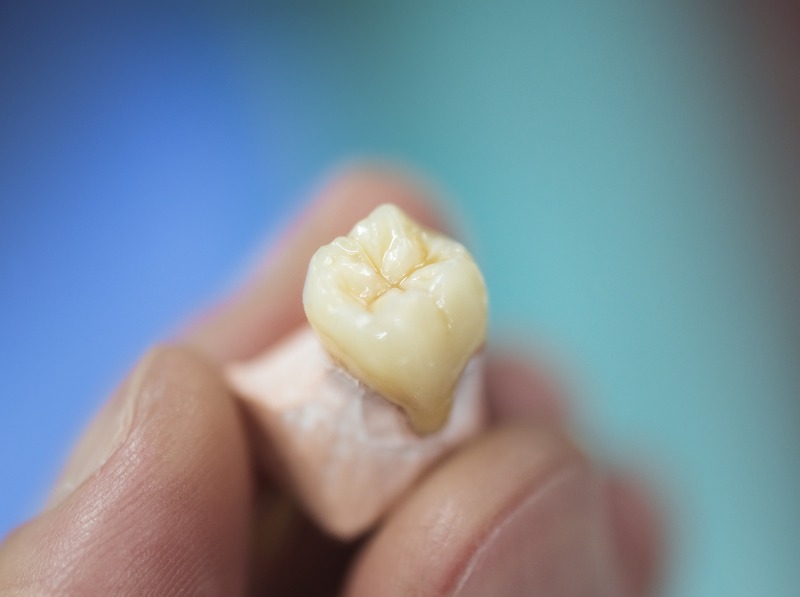 Why Dentists Recommend Dental Crowns Before a Tooth Cracks CompletelyBy Lansdowne Dental Centre