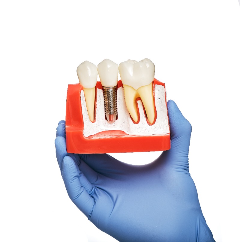 Dental Implant Procedure: A Step-by-Step Guide from Dr. Tang