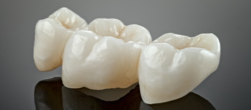 Dental Bridge for Missing Tooth: What It Is and When It's the Right OptionBy Dr. Tang, Lansdowne Dental Centre, Richmond, BC