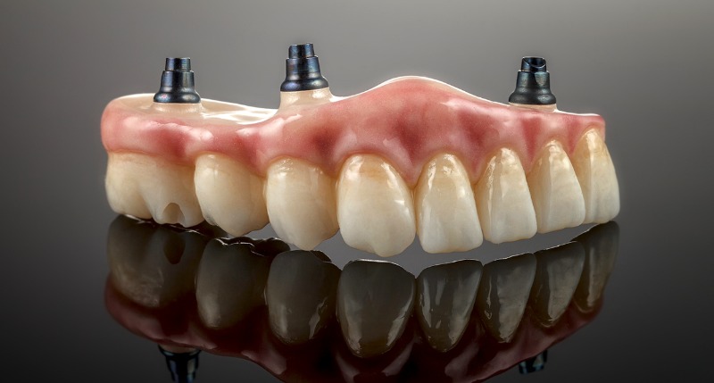 Implant-Supported Dentures vs. Conventional Dentures: Which Option Is Right for You?