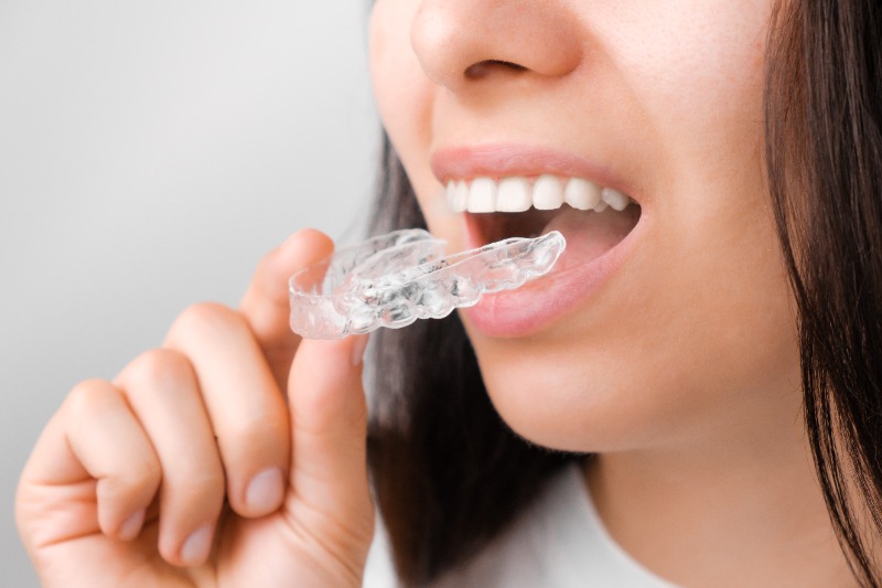 What to Expect During Invisalign Treatment: From Your First Scan to Your Final Retainer