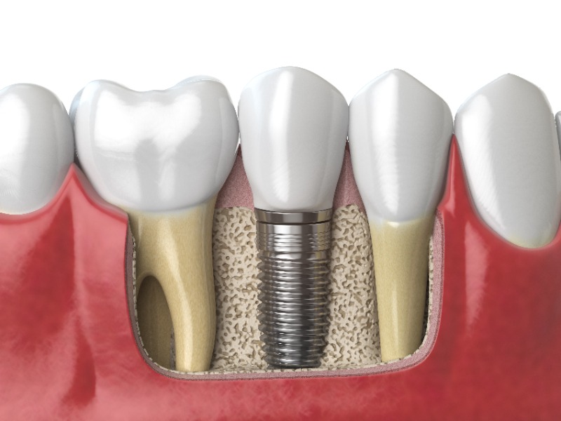 Why Dental Implants Are Often Considered the Gold Standard for Tooth Replacement